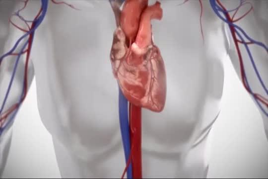 Heart Failure Device Tested for First Time in US (2 of 2)