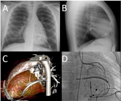 The Danger of Coronary Artery Compression in Children Is More Common Than We Think