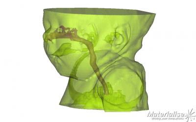 Computer Models for Pediatric Airway Problems