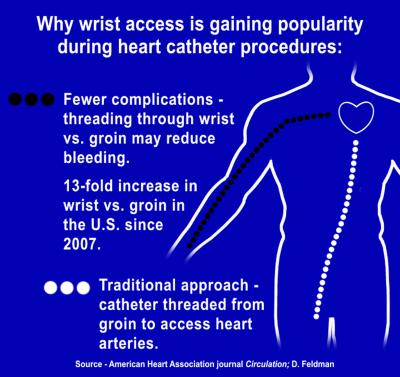 Why Wrist Access Is Gaining Popularity during Heart Catheter Procedures