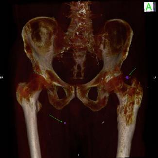 CT Scan of Former WW2 solider