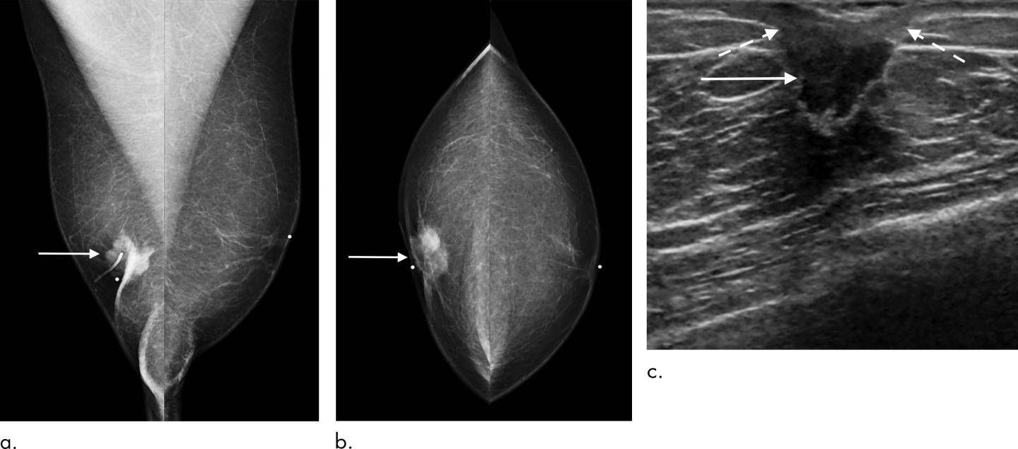 Screening Mammography Could Benefit Men at High Risk of Breast Cancer