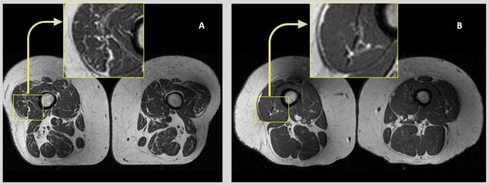 Axial T1-weighted bilateral thigh MR images