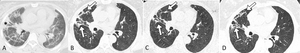 Chest CT Shows Lung Abnormalities Two Years after COVID