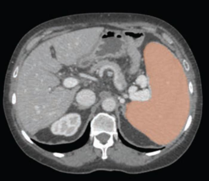 60-year-old woman with cirrhosis and portal hypertension, who underwent contrast-enhanced CT as pre-liver transplant evaluation