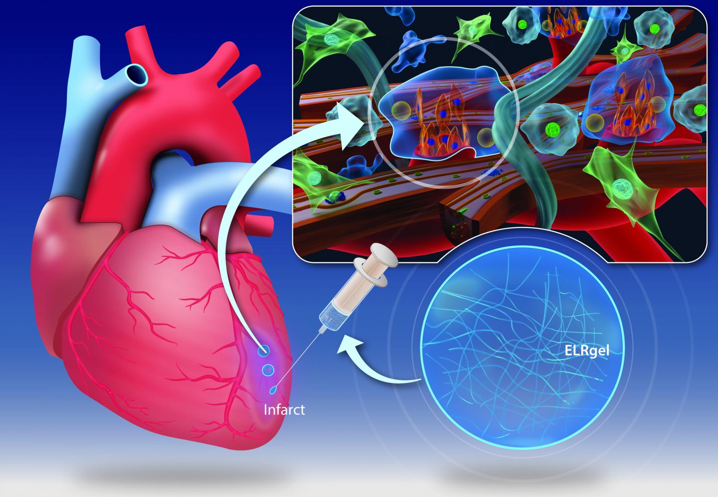 Graphic of heart and injectable hydrogel