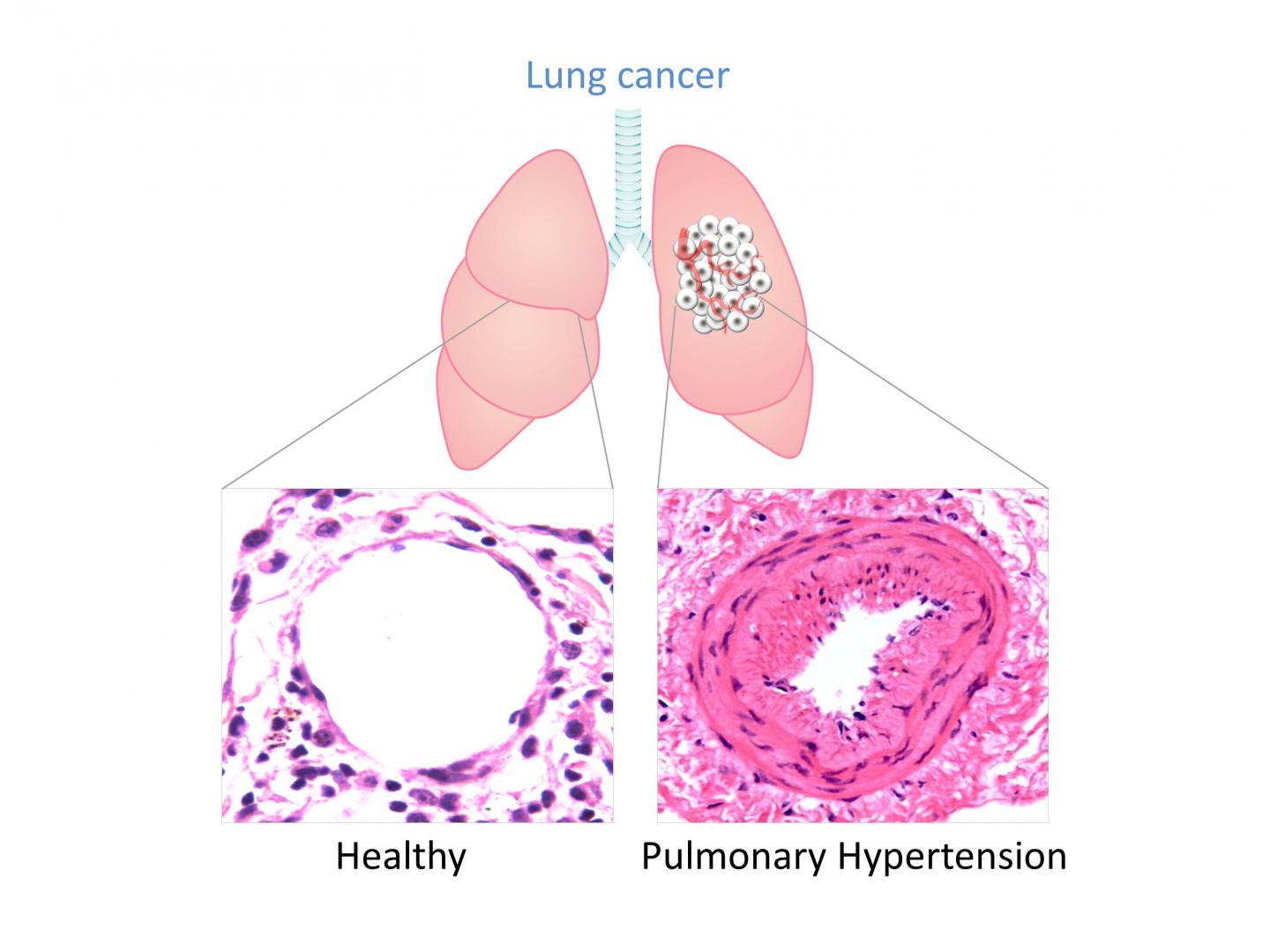 A Sigh of Relief: Insights into Why Lung Cancer Causes Breathing Difficulties (8 of 8)