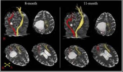Diffusion Tensor Tractography