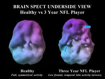 Brain SPECT, Brain Scan