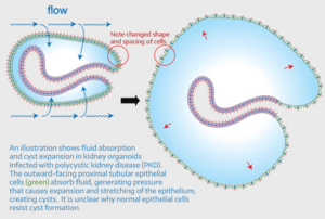 1-PKD cyst expansion