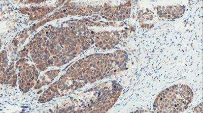 Comparing Combination Therapies for Advanced Head and Neck Cancer Shows No Improvement