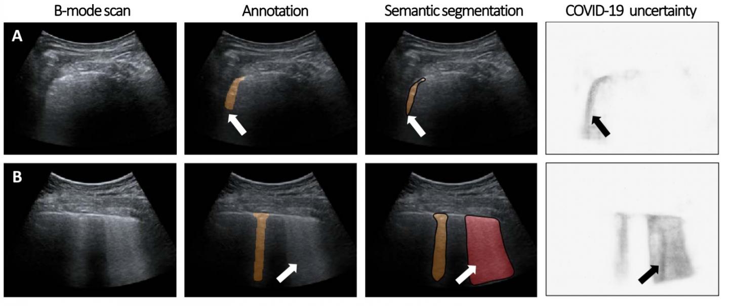 Ultrasound Data Analyzed by the Algorithms
