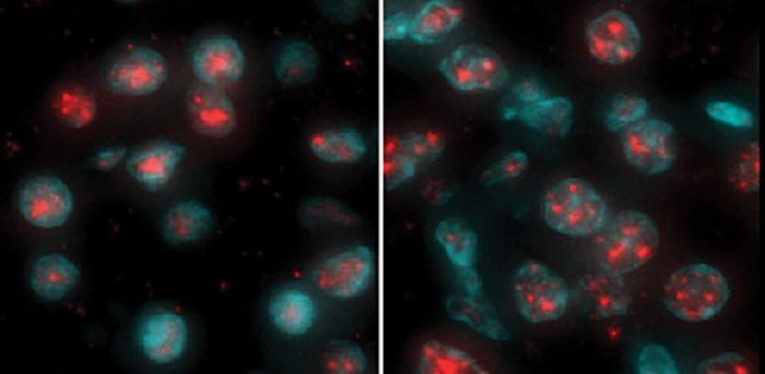 Nuclei of ccRCC cells and nuclear speckles