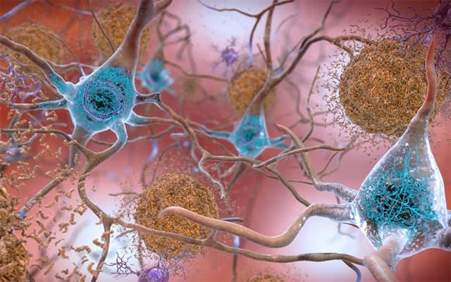 Artist Rendering, Amyloid Plaques