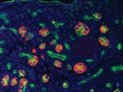 Master Switch for Pancreatic Cancer