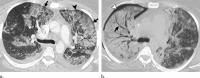 Abnormal Imaging Findings Key to EVALI Diagnosis in Vapers (2 of 3)