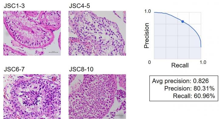 Examples of the pathological images for JSC1-3, 4-5, 6-7, and 8-10, and accuracy of image classification