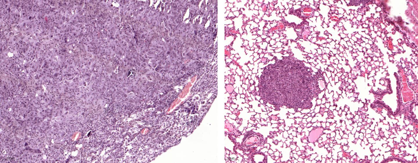 Lung Tumors