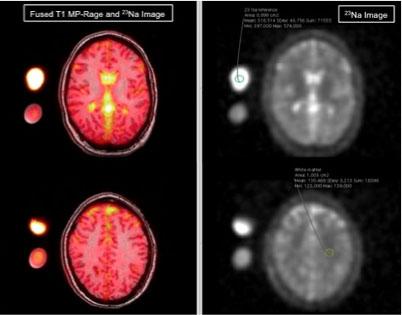 Migraines Linked to High Sodium Levels in Cerebrospinal Fluid