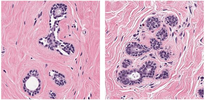 AI algorithms performed well on easier breast cancer image patches, like these.