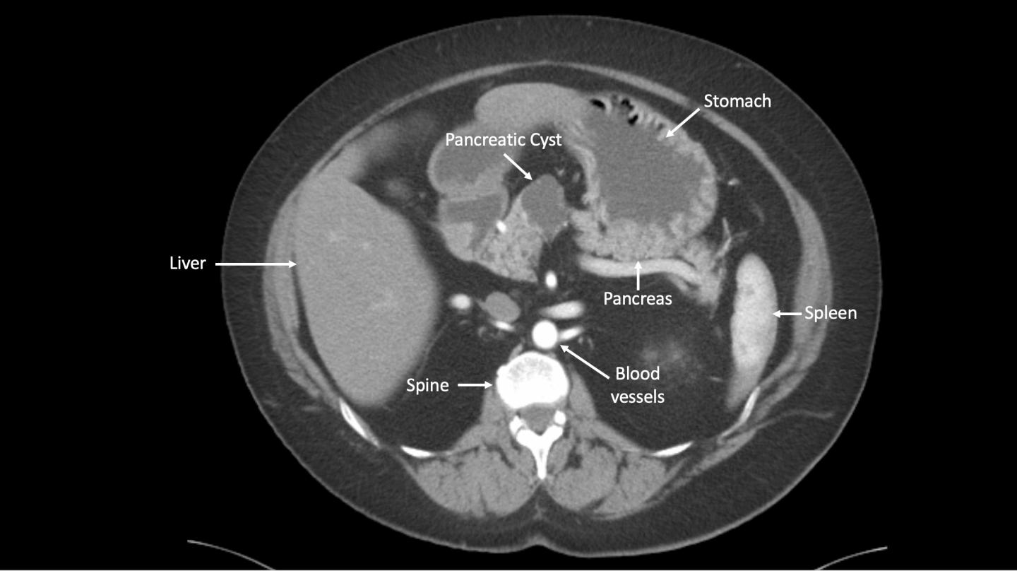 Pancreas Cyst