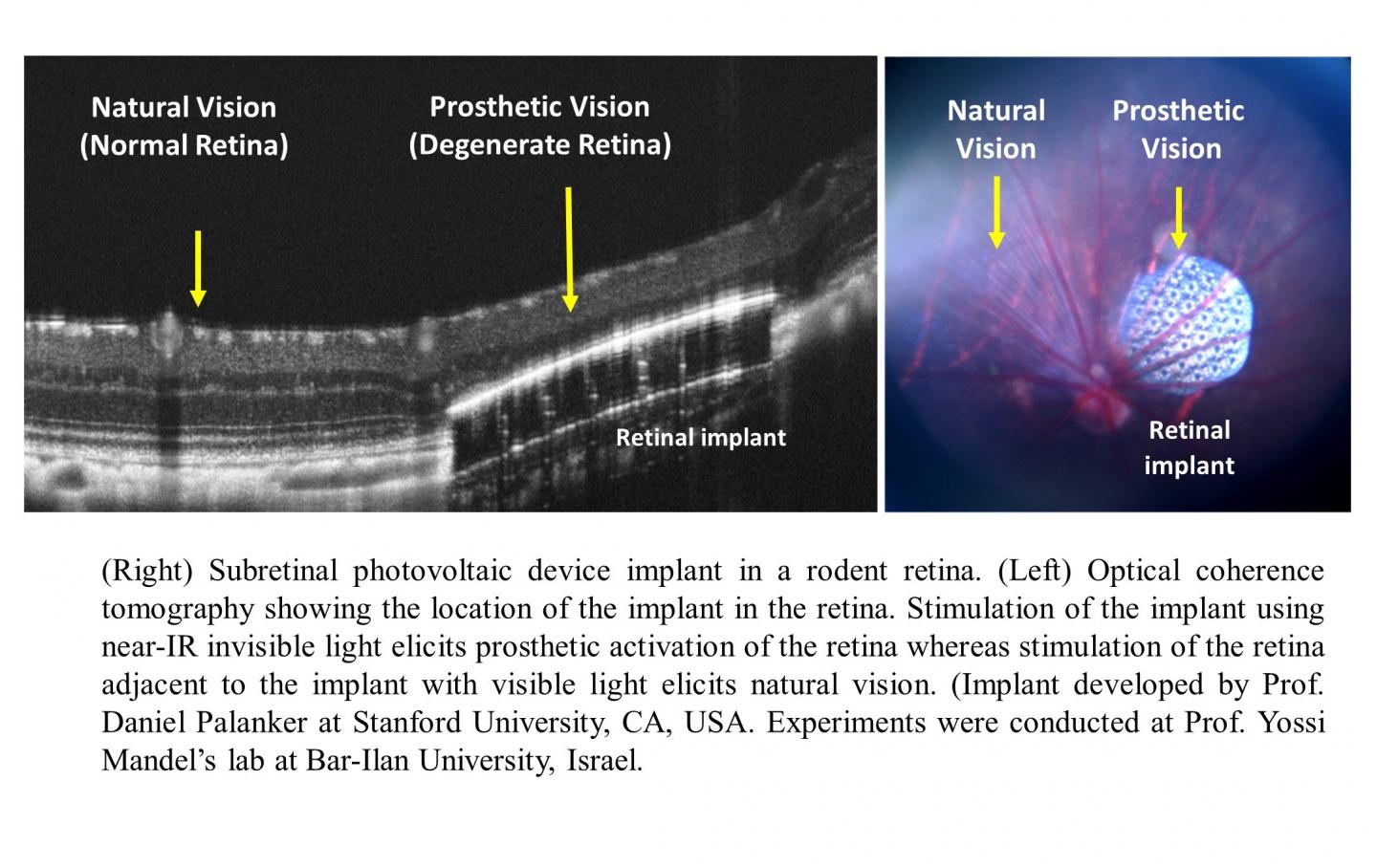 The Brain Can Combine Natural and Artificial Vision to Help Treat a Common Form of Blindness