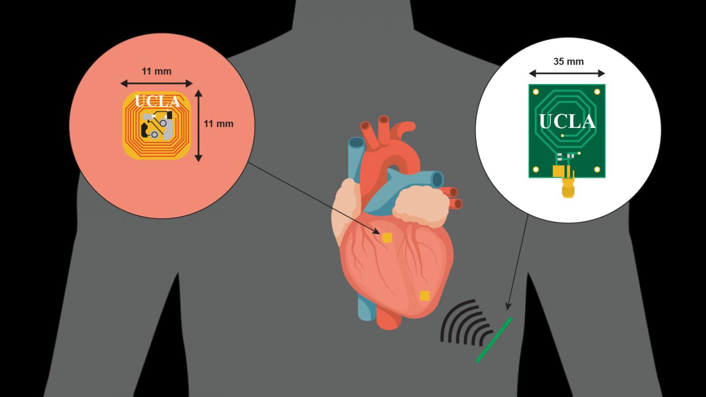Doctors Successfully Synchronize both Sides of the Heart with Promising New Wirelessly Powered, Lead