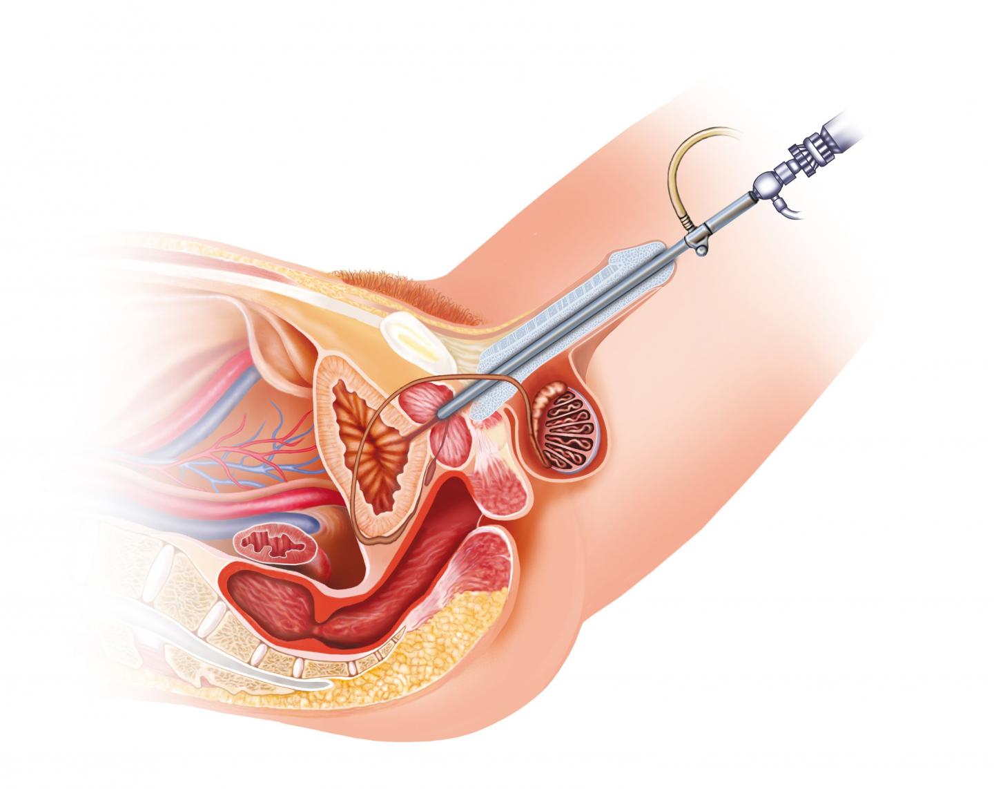 Bladder Cancer Cystoscopy