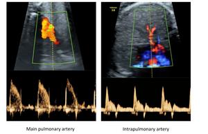 Pulmonary vascular reactivity in growth restricted fetuses using computational modelling and machine learning analysis of fetal Doppler waveforms