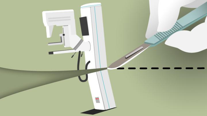 Many Women Get Unnecessary Mammograms before Breast Reduction Surgery