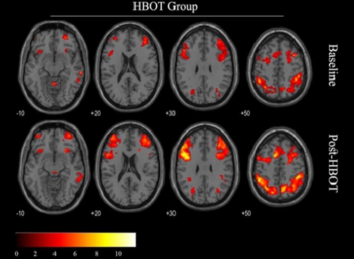 Functional MRI before and after HBOT