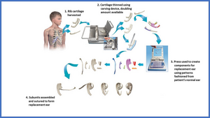 Ear reconstruction