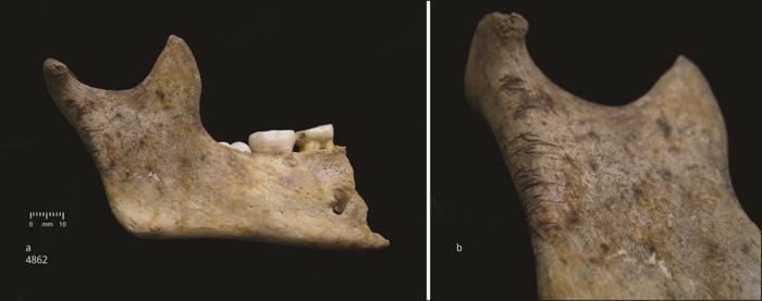 Mandible of child.