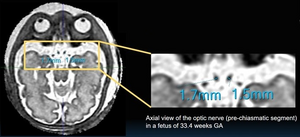 Optic nerve measurement