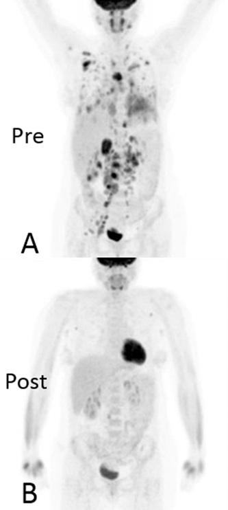 Pre and 3 Months' Post Treatment