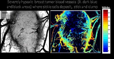 Hypoxic Vessels in a Breast Tumor