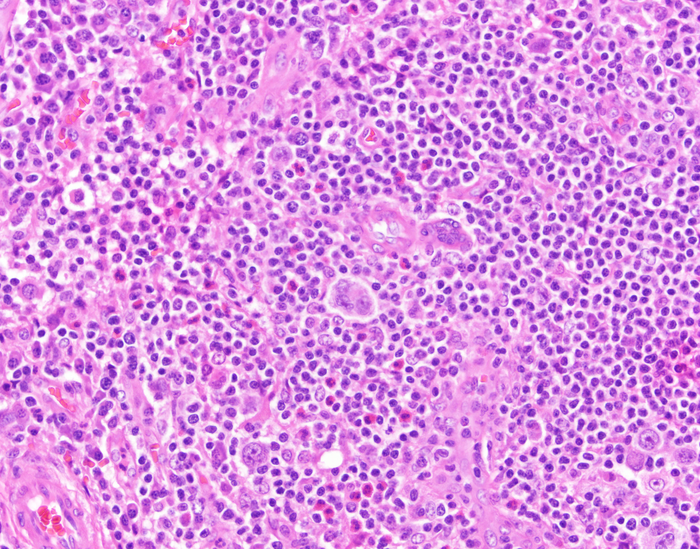 CHL- Classic Hodgkin Lymphoma