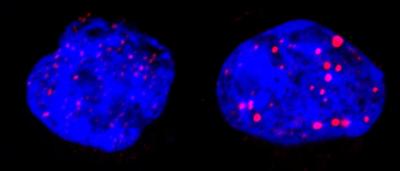 Leukemic Cells Before and After Treatment