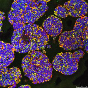 3D model of prostrate cancer