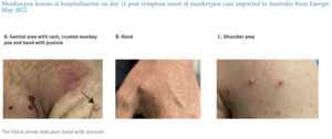 Monkeypox lesions