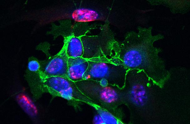 Sample of Lung Fibrosis