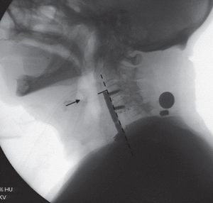 anterior cervical spine surgery