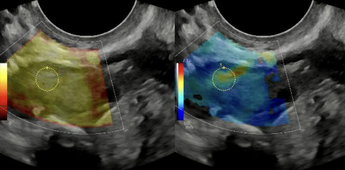 Human ovary ultrasound