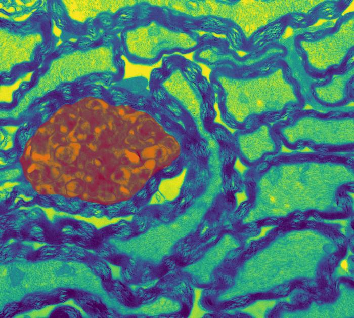 Axonal swelling