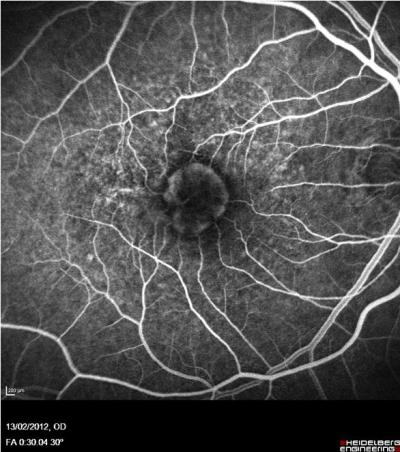 The Fluorescein Angiogram of An Eye with Wet AMD