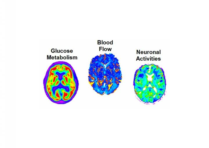 Brain Scans of Amyloid Concentration