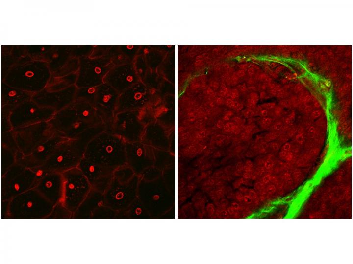 Representative Images of Normal Cervical Tissue (Left) and Cervical Cancer (Right)