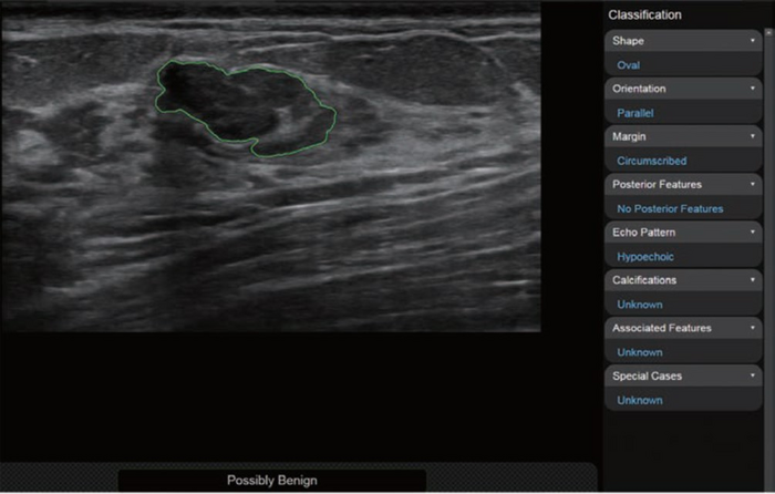 Subsequent ultrasound was performed by radiologist without breast ultrasound expertise for investigational purposes.