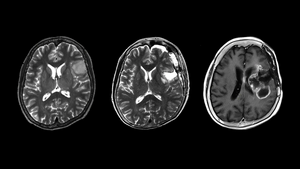 Astrocytoma