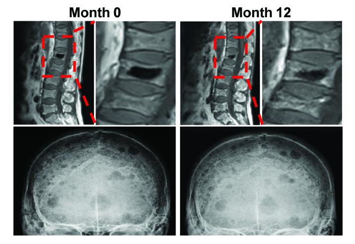 Renegade Fat Cells Induce Bone-Damaging Lesions in Multiple Myeloma (1 of 1)